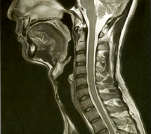 脊椎MRI